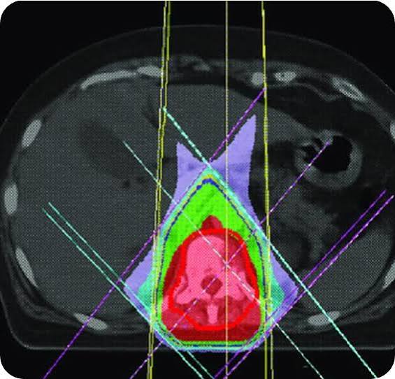 Home 5 HCG CCK Cancer Centre 3D Conformal Radiation Therapy HCG Cancer Centre HCG CCK Cancer Centre