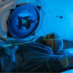 Stereotactic Body Radiation Therapy (SBRT)
